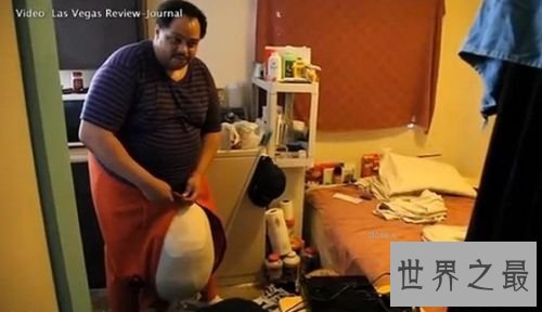 世界上最大的睾丸，重达120斤(太大影响正常生活)