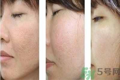 ​皮肤毛孔粗大原因有哪些？如何预防皮肤毛孔粗大？