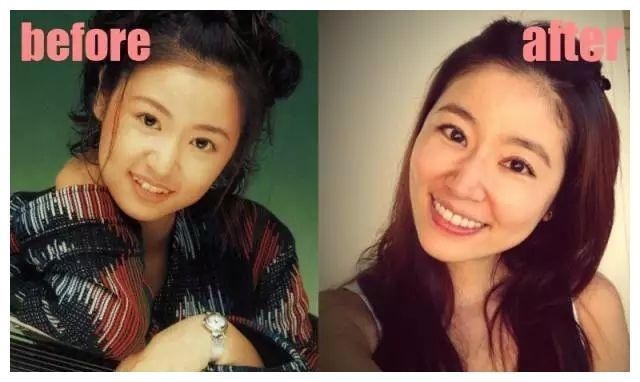 明星为什么都是一口烤瓷牙？整完牙齿他们和从前不一样了！