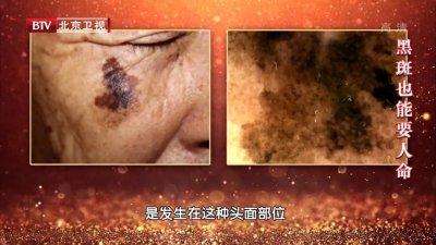 ​这三种斑，不痛不痒却可能是癌症信号！45岁以上的人要留神~