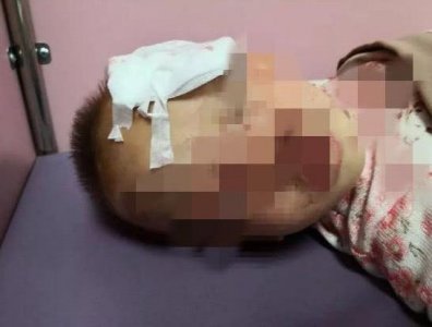 ​一岁女婴被小区恶犬咬伤脸部惨遭毁容，狗主人不认账：谁能证明