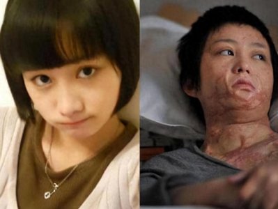 ​周岩：因拒绝官二代同学求爱，被泼汽油毁容，如今已涅槃重生