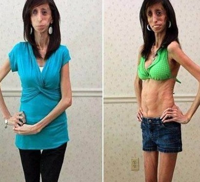 女子高1.57米体重54斤，被称为“骷髅女孩”