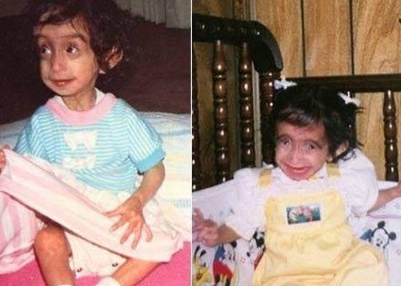 女子高1.57米体重54斤，被称为“骷髅女孩”