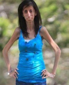 ​女子高1.57米体重54斤，被称为“骷髅女孩”