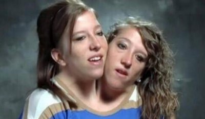 ​美国连体人阿比盖我和陈列塔妮近况，坠入情感纠葛